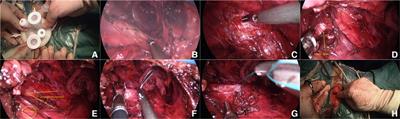 A preliminary clinical report of transvaginal natural orifice transluminal endoscopic Sacrospinous Ligament Fixation in the treatment of moderate and severe pelvic organ prolapse